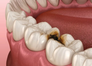 Les différentes reconstructions de la dent