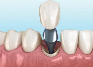 Dr Papin cabinet dentaire Dr Droesch reconstruction dent